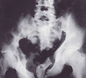 骶骨骨折可以做家务吗【相关词_ 骶骨骨折可以评残吗】